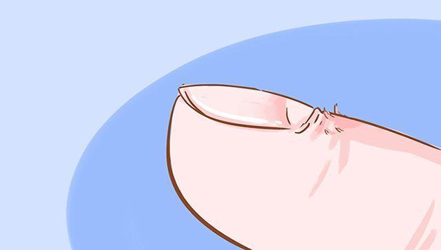 手指甲起倒刺缺维生素什么,手指甲倒刺缺维生素