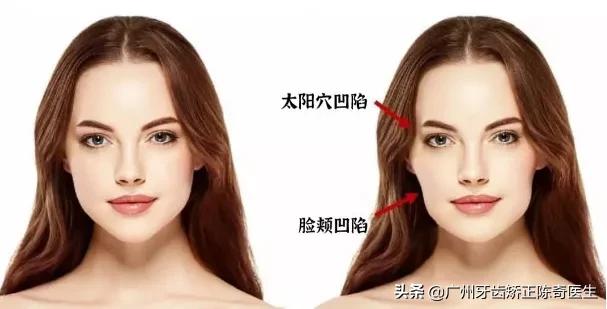 戴牙套会有下颌线,戴牙套的时候人会变丑吗