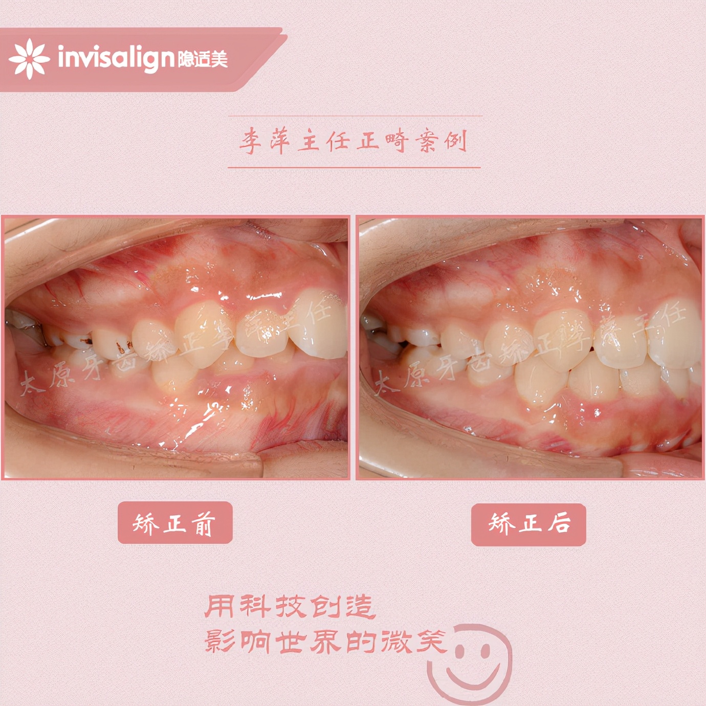 太原牙齿隐形矫正,太原牙齿正畸贵吗