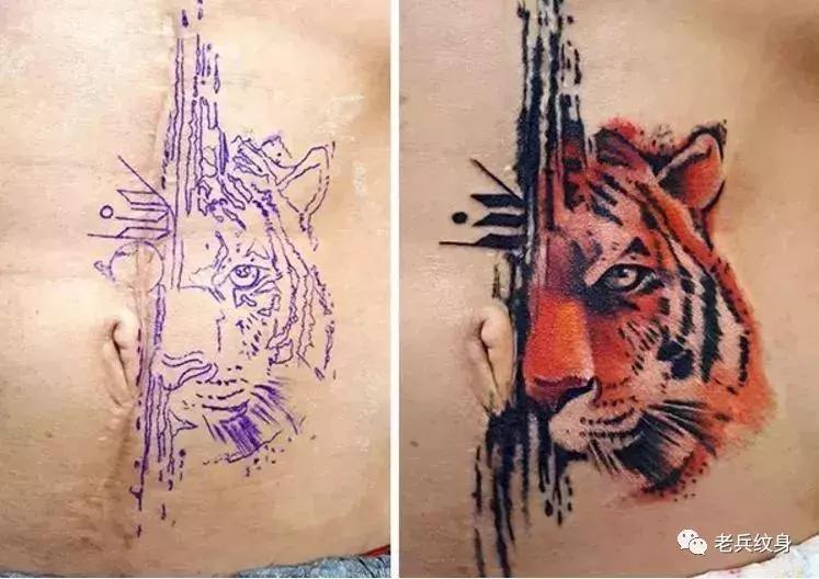 疤痕体质可以用纹身去遮盖疤痕吗,你的疤痕是什么颜色呢