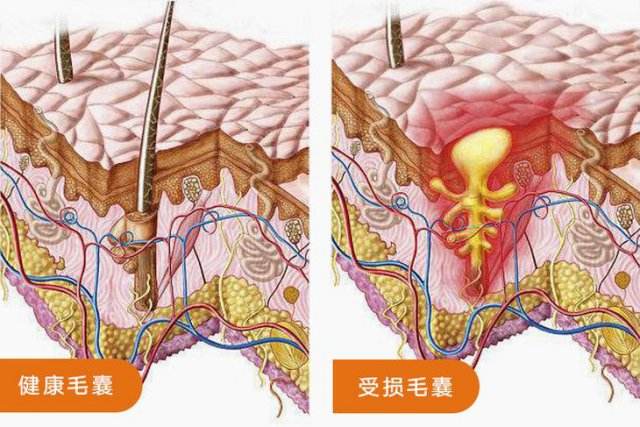 头发脱发毛囊堵塞怎么治疗,毛囊堵塞导致脱发