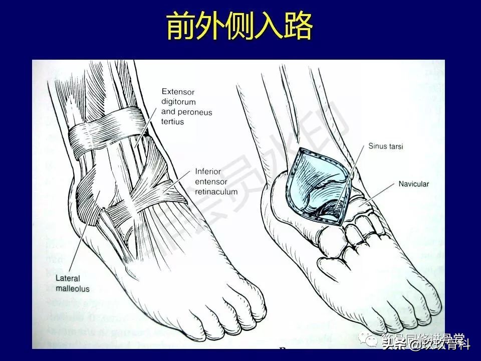 距骨骨折的治疗原则,距骨骨折如何调理