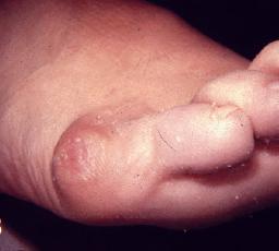 小脚趾滑囊炎警惕四种病,小脚趾拇囊炎怎么治疗