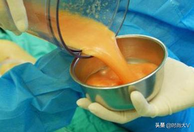 为什么不建议做抽脂,为什么不建议抽脂手术