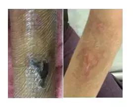 输液时肌腱损伤怎么办,输液造成组织坏死