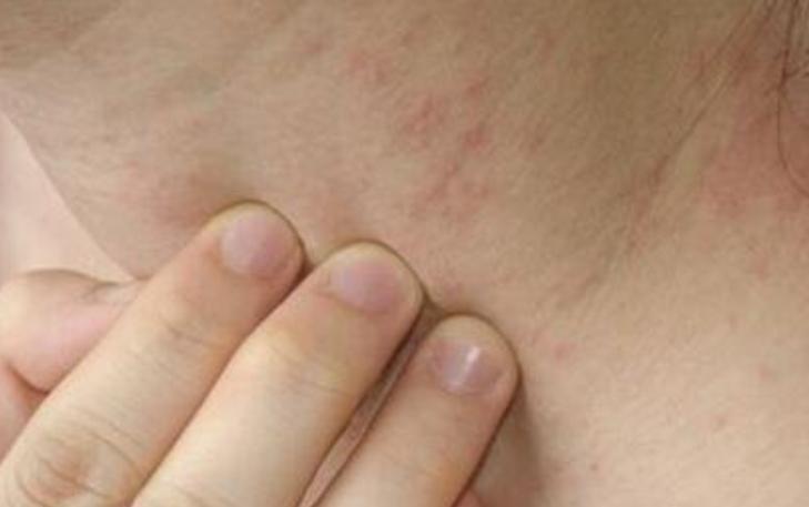 婴儿湿疹哺乳妈妈应少吃什么,湿疹可以少吃一点葱吗