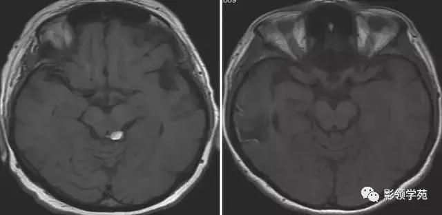 头部t1wi信号不均匀增高,脑t1wi和t2wi稍低信号