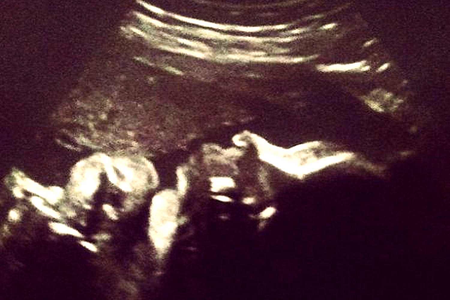 宝宝出生就没有双手双脚，原因在于父母，如何预防胎儿畸形