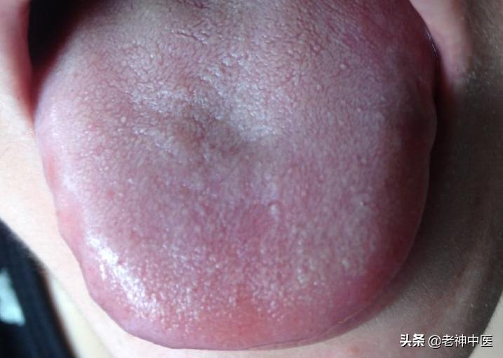 「中医案例」中医治愈糖尿病肾病，案例分析；糖尿病肾病如何分期