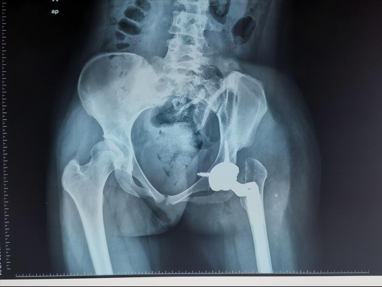 AI助力精准处理IV型髋关节发育不良花季少女翻开人生新篇章