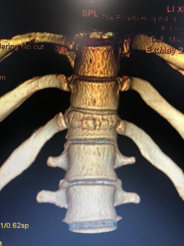摔跤了坐起来腰部很疼是什么原因,摔跤腰扭伤阴天疼痛后遗症