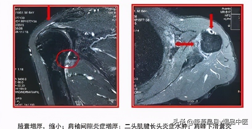 冻结肩一招解决,冻结肩怎么调