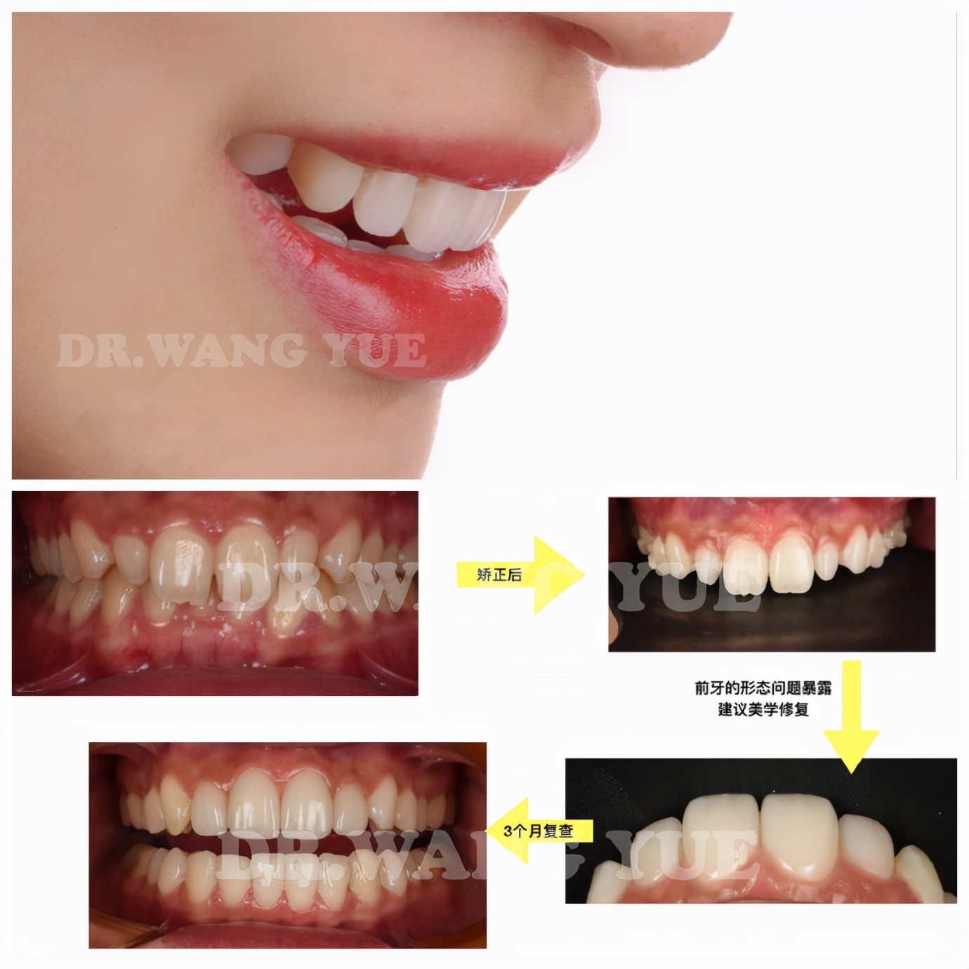 上海牙齿贴面美白修复,矫正牙齿的黑三角瓷贴面