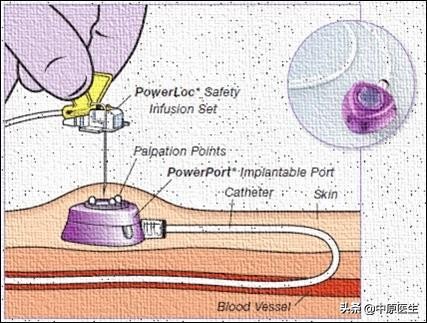 温馨的静脉输液港：为2岁化疗患儿提供长期静脉通道，不影响洗澡