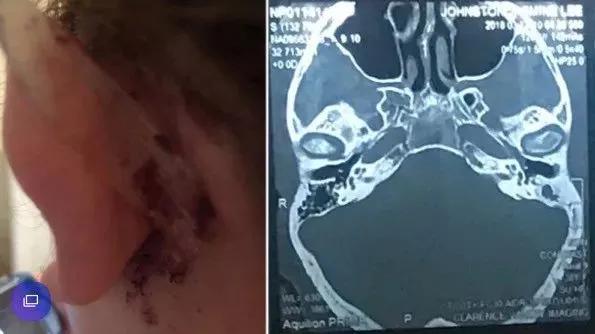 一男子掏耳朵掏出血,长期掏耳朵导致患癌