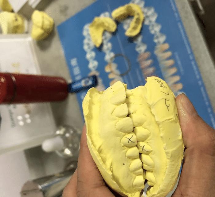 牙套隐形日记,牙套日记正颌