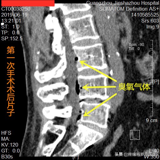 腰椎间盘突出神经根粘连能自愈吗,腰椎微创手术后神经根粘连怎么办