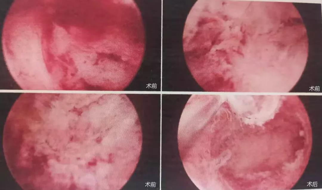 宫角妊娠术后健康宣教,宫角妊娠有没有生命危险