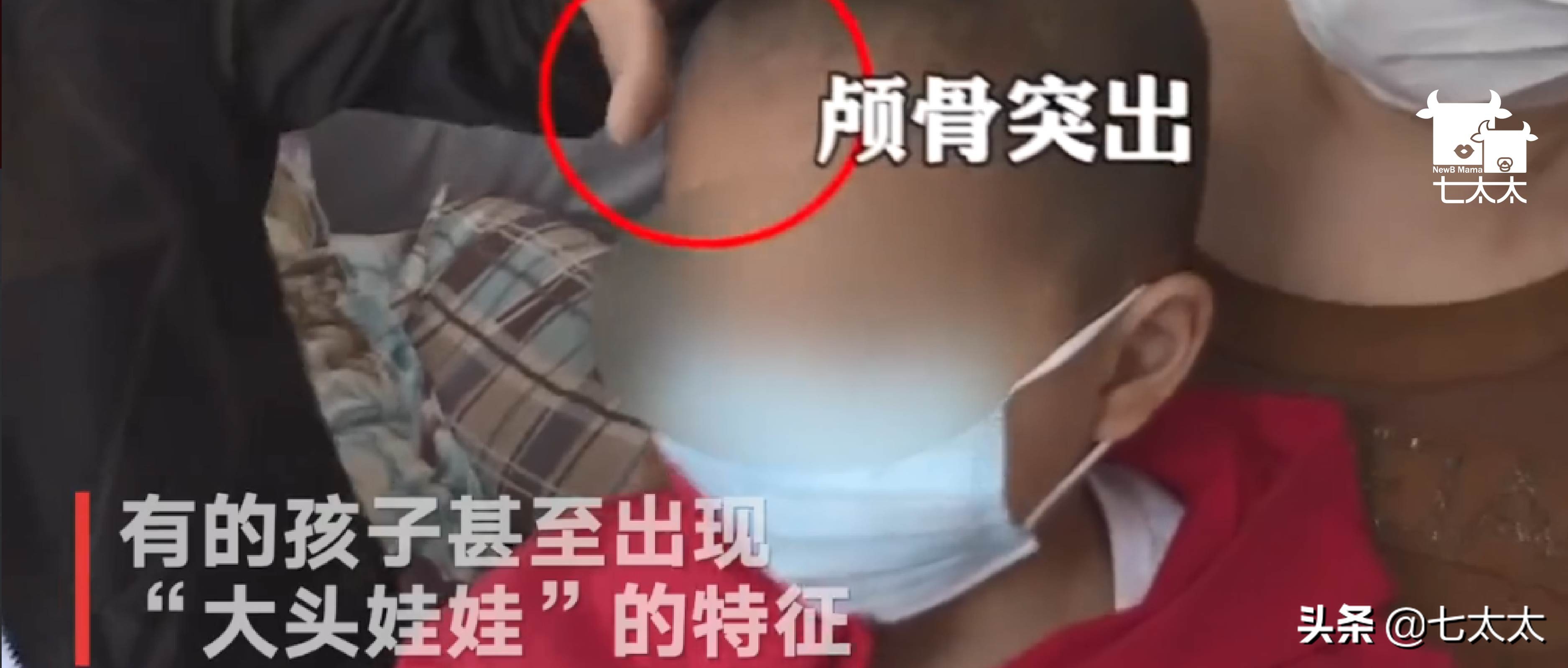 假奶粉大头娃娃特征,假奶粉大头娃娃现在怎么样了