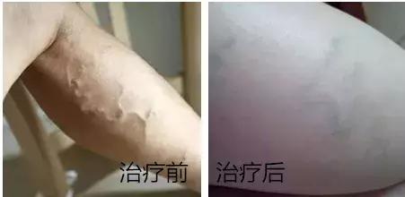 蚯蚓腿新式微创治疗,蚯蚓腿微创手术