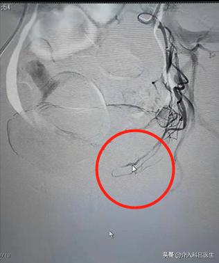 多发子宫肌瘤手术后如何避免复发,多发性子宫肌瘤手术发现内膜增生