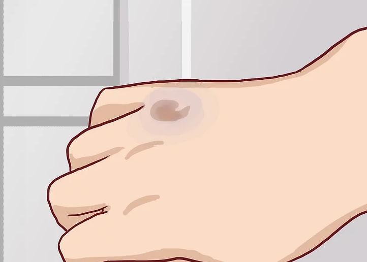 手骨折反复疼痛怎么办,手痛了一个月是骨折吗