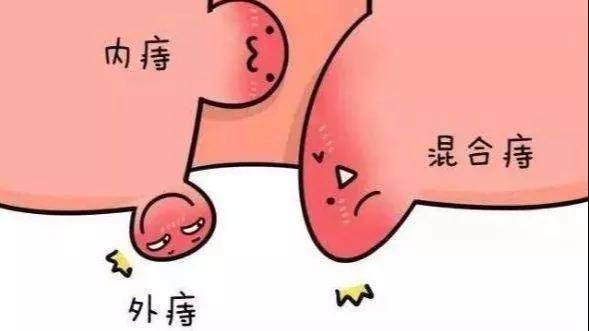 关于痔疮你了解多少呢？应该如何预防好呢？