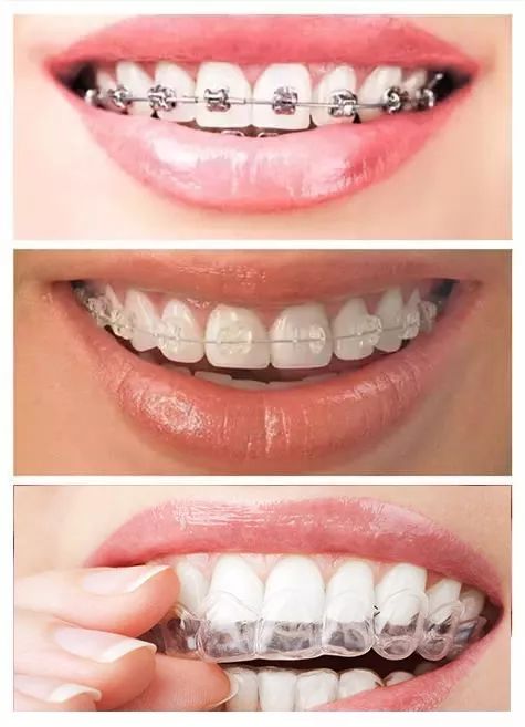 牙齿矫正隐形牙套价格,你的牙花了多少钱