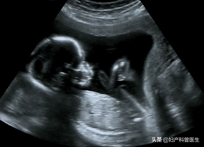 孕期B超检查做多了会引起胎儿畸形?做几次合适,需要注意什么?