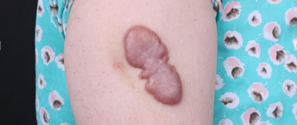 疤痕疙瘩可以去除吗?如何去除?