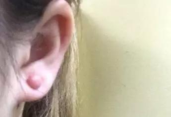 剖腹产的疤痕增生怎么除疤,疤痕体质如何才能正确除疤