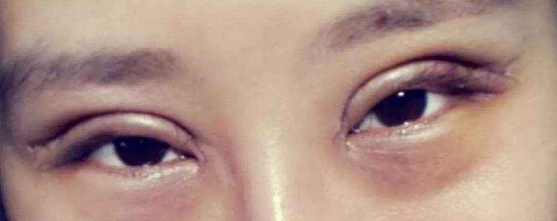 双眼皮几千和几万的区别,双眼皮一万多贵不贵