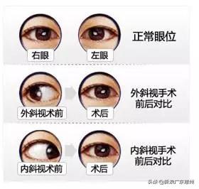 爱尔眼科公益救助活动方案,公益救助贫困儿童