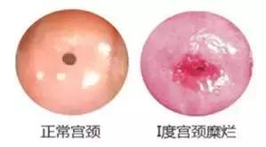 宫颈糜烂二度宫颈肥大宫颈囊肿,宫颈糜烂肥大囊肿会引起宫颈癌吗