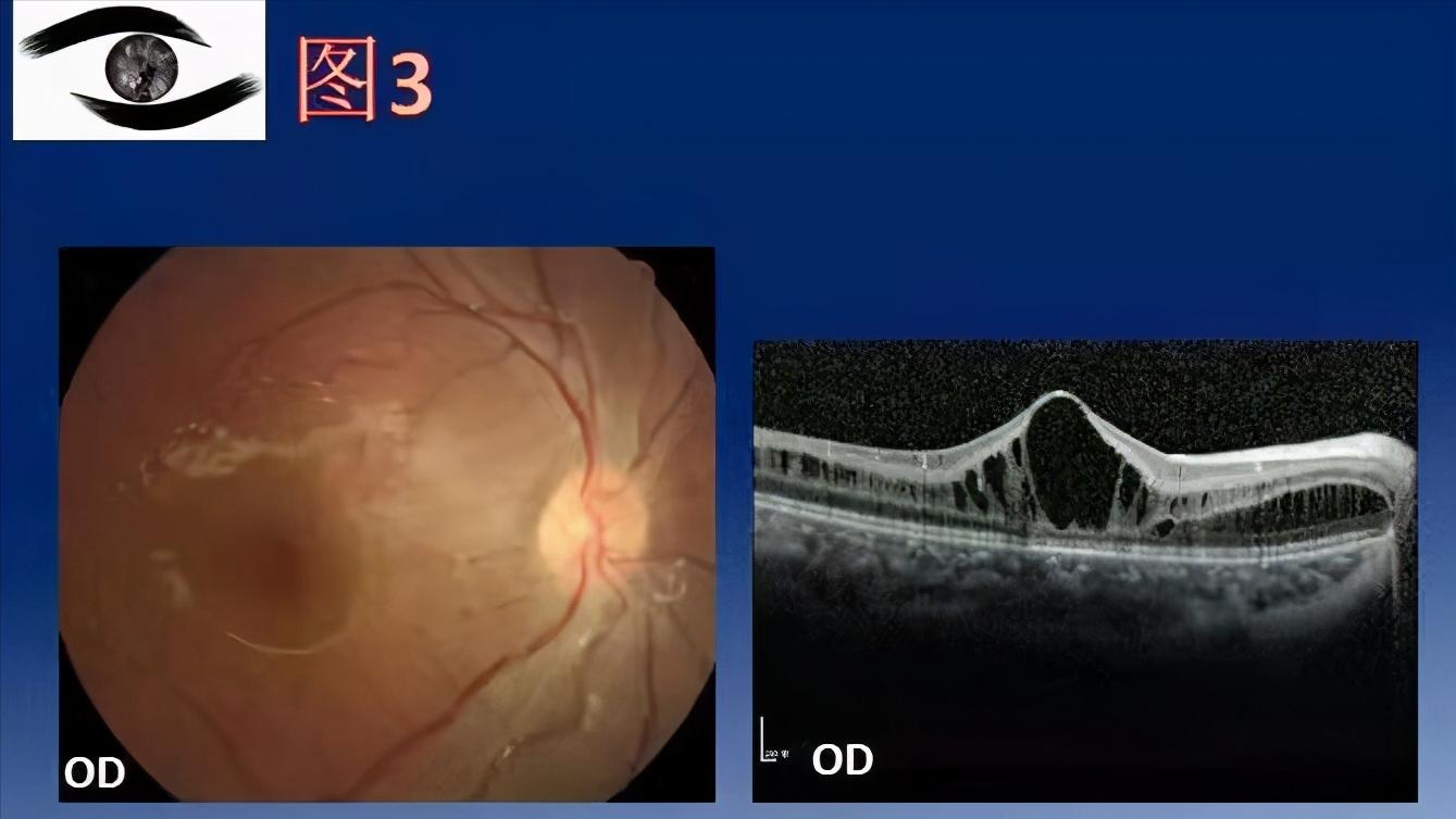 视网膜色素变性是一种常见眼病吗,视网膜色素变性是什么病