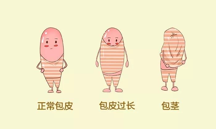 男子自己网购包皮切割器,男子自己买包皮切割器