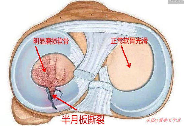 磁共振图片讲解半月板损伤的程度,磁共振半月板损伤严重