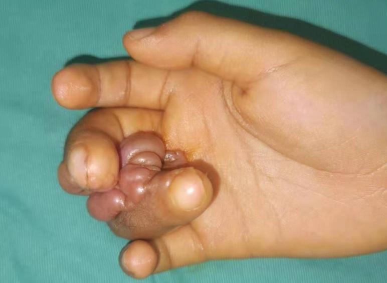 并指畸形免植皮案例,并指畸形