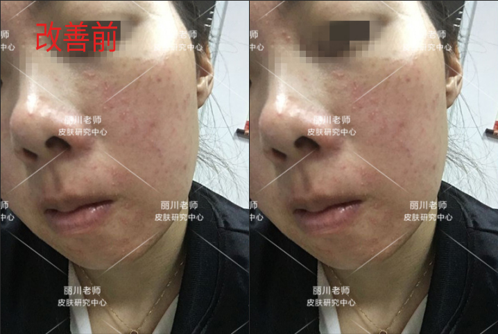 兰亭护肤品能治疗激素脸吗,兰亭化妆品嫩白祛斑霜