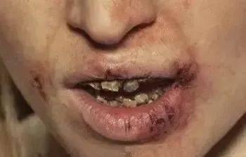 吸笑气吸到大小便*禁失**、把亲妈鼻梁打断....被*品毒**彻底毁掉的年轻人