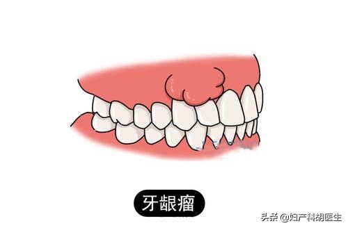 一颗坏牙会引起上下牙都痛吗,一颗牙坏了会不会影响满口牙疼