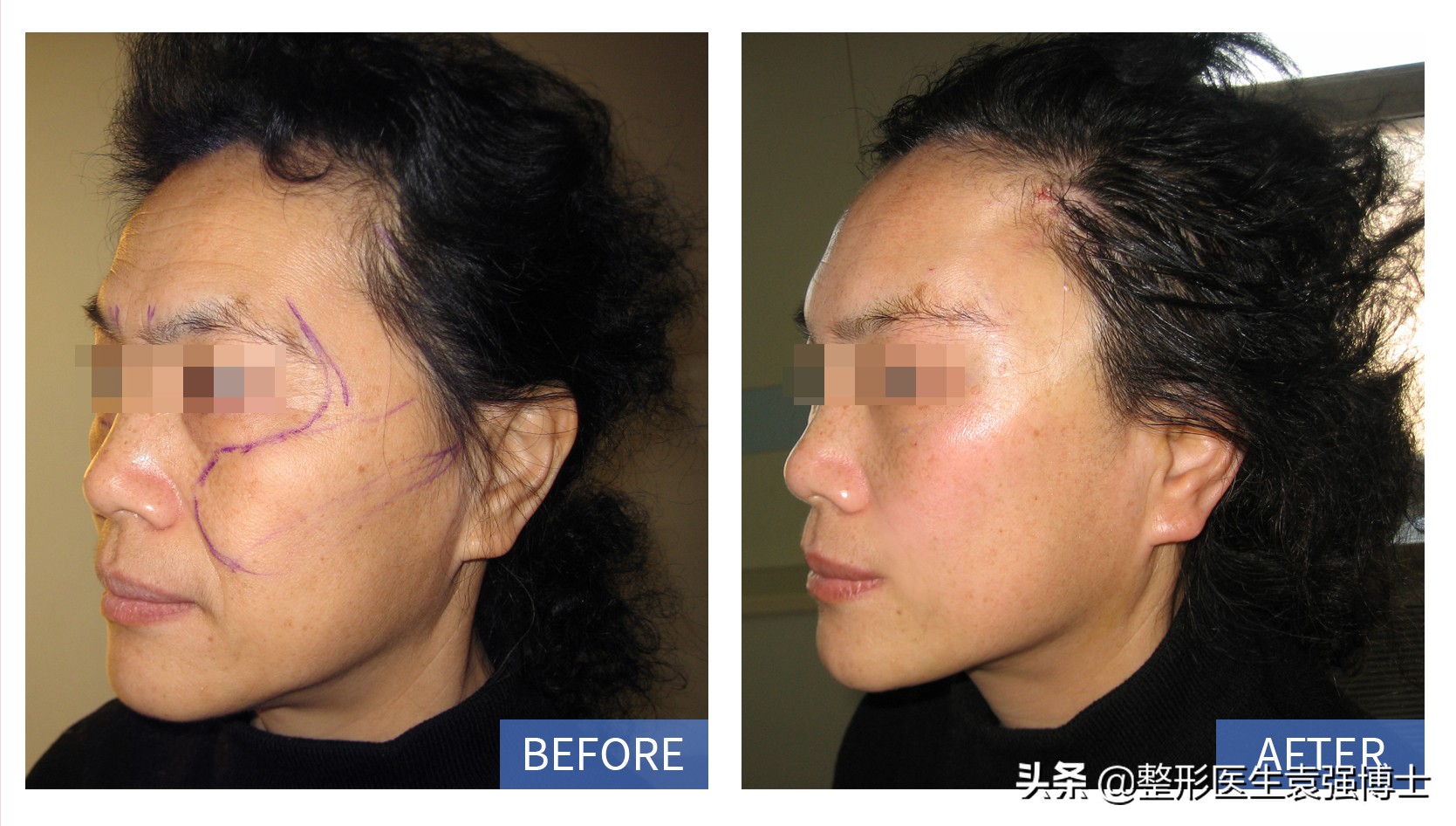 面部除皱用什么方法效果最好,目前面部除皱最安全有效的方法