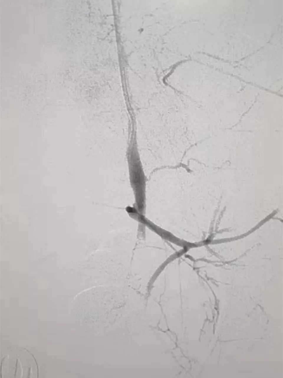 孕妇大出血抢救成功几率,孕妈大出血