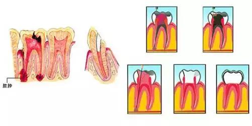 牙齿折断了能接回去么,牙外伤根中三分之一折断怎么处理