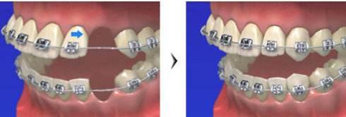 龅牙属于复杂正畸吗,整齐的龅牙是不是最好矫正的