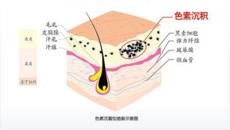 国际上有根除遗传雀斑的方法吗,专业祛斑四天根除遗传性雀斑