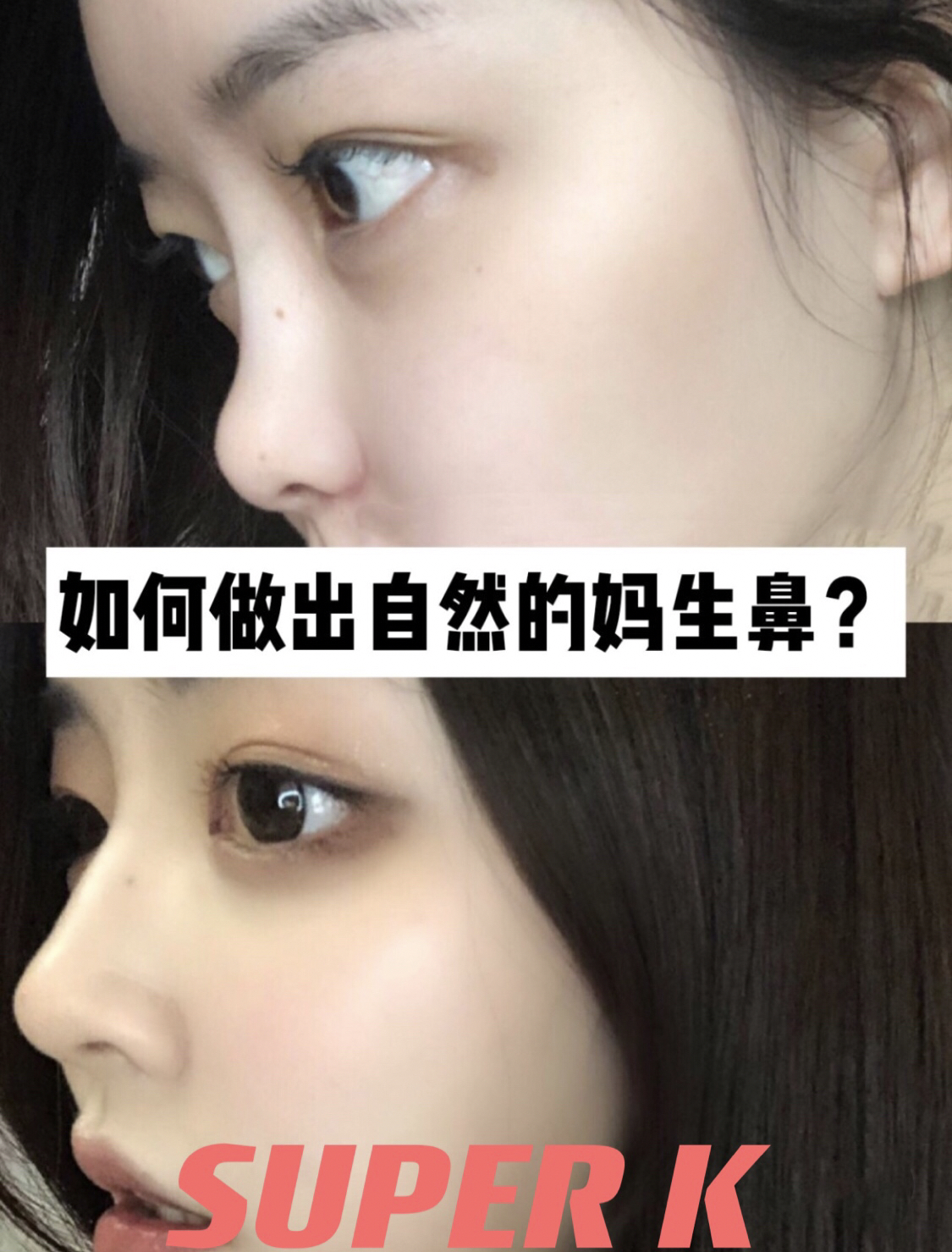 2022年流行鼻整形的全过程视频,大宽鼻手术案例