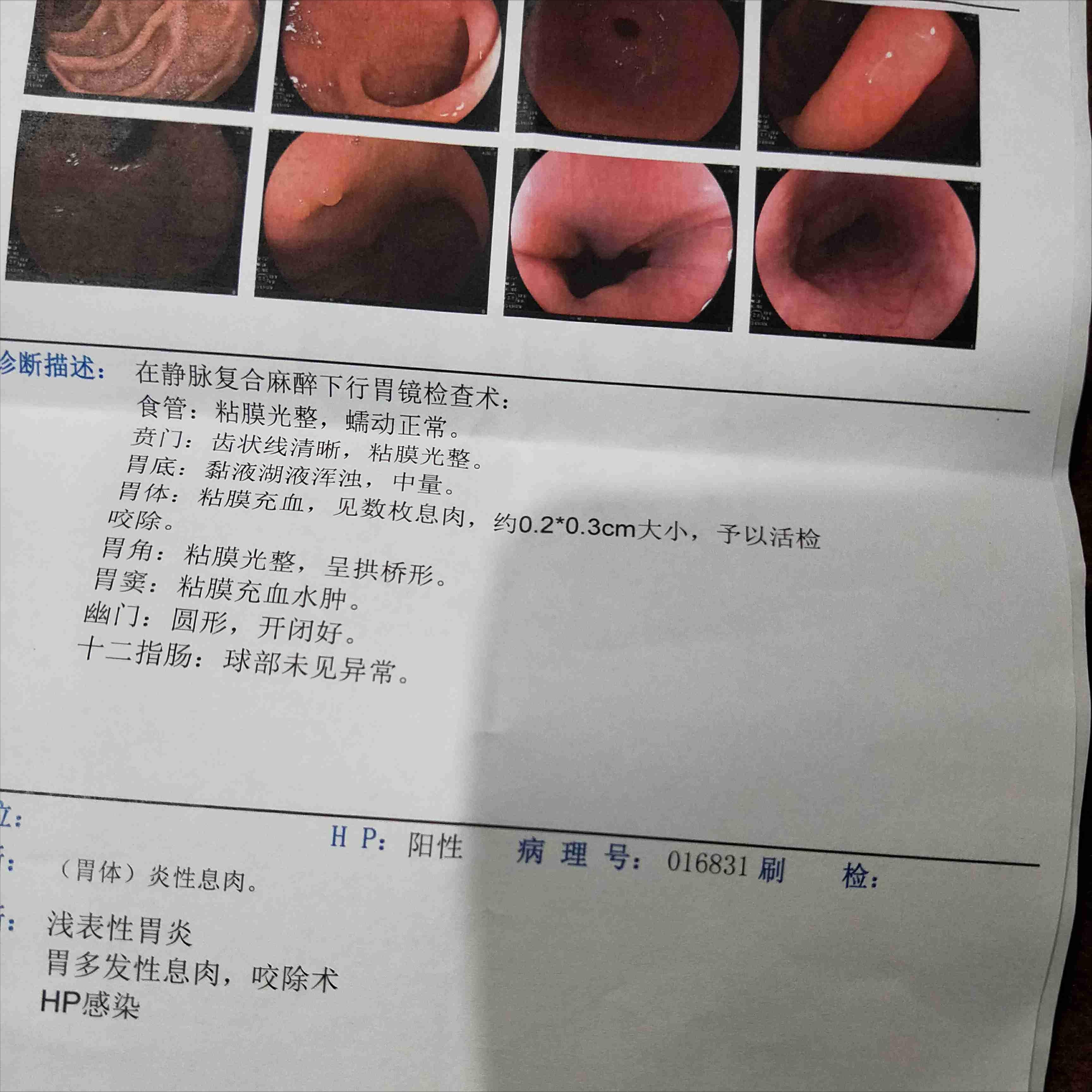 结节息肉囊肿增生哪个更容易癌变,结节囊肿增生息肉有什么区别