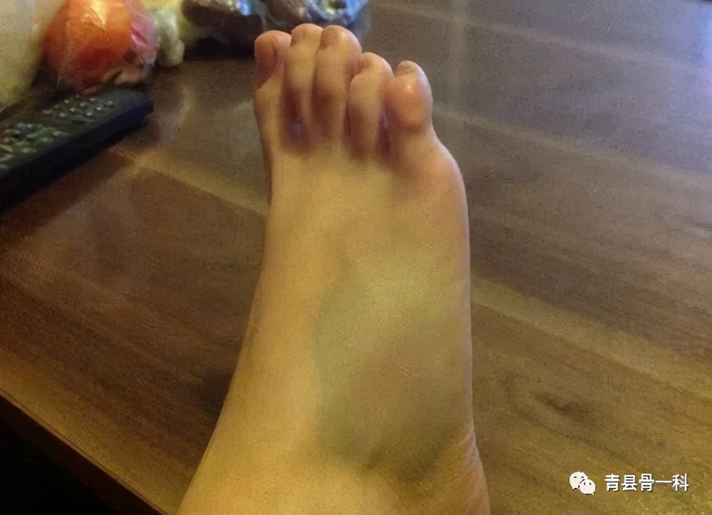 脚崴了肿了但是走路不疼怎么办,脚崴了不肿但走路就疼怎么处理