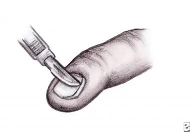 困扰小岳岳的甲沟炎,有没有好的治疗方法?医生给相声粉丝的科普